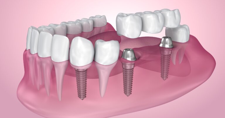 Dental implants services